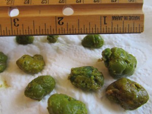 gallbladder stones 2